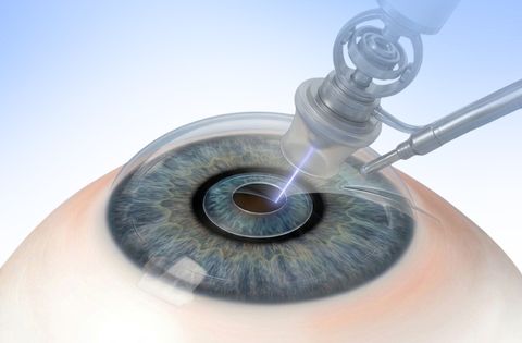 Robotic Refractive Cataract Surgery FLACS