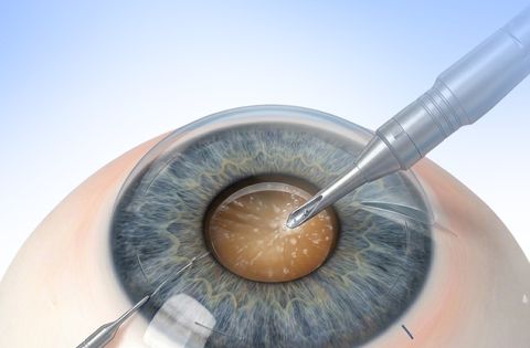Traditional Cataract Surgery MICS