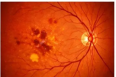 Diabetic Retinopathy