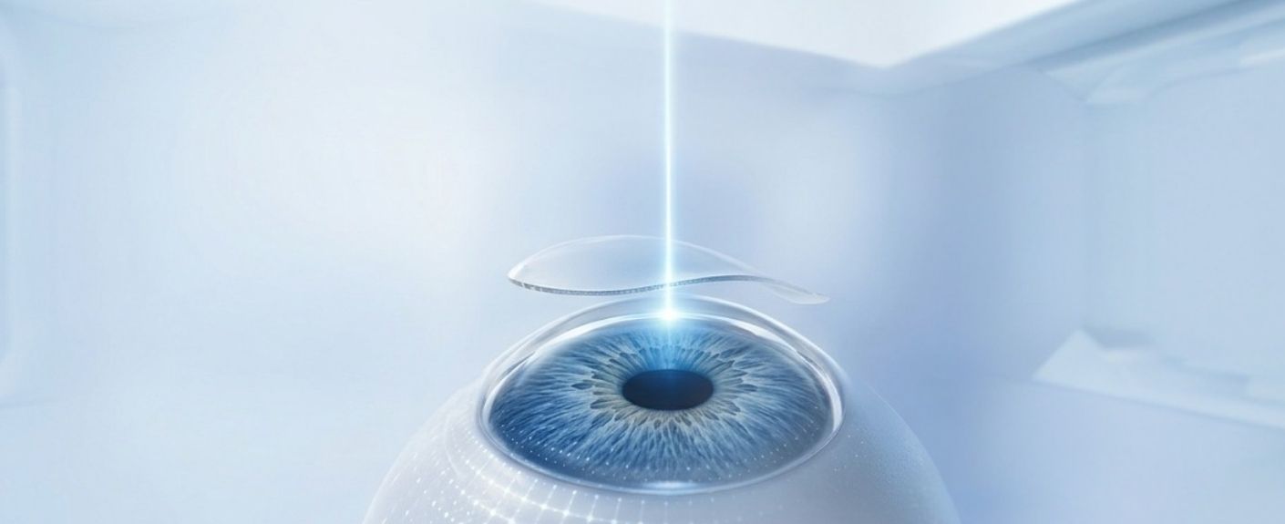 Femtosecond Laser Eye Surgery Guide