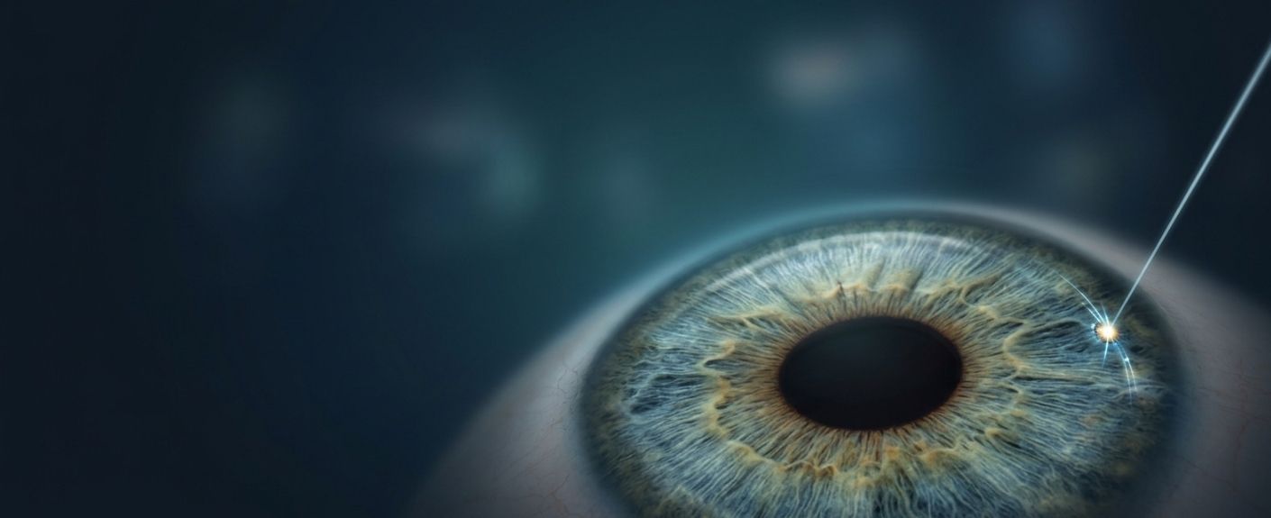 Laser Iridotomy Procedure: Benefits and Risks