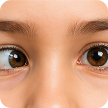 Strabismus Squint