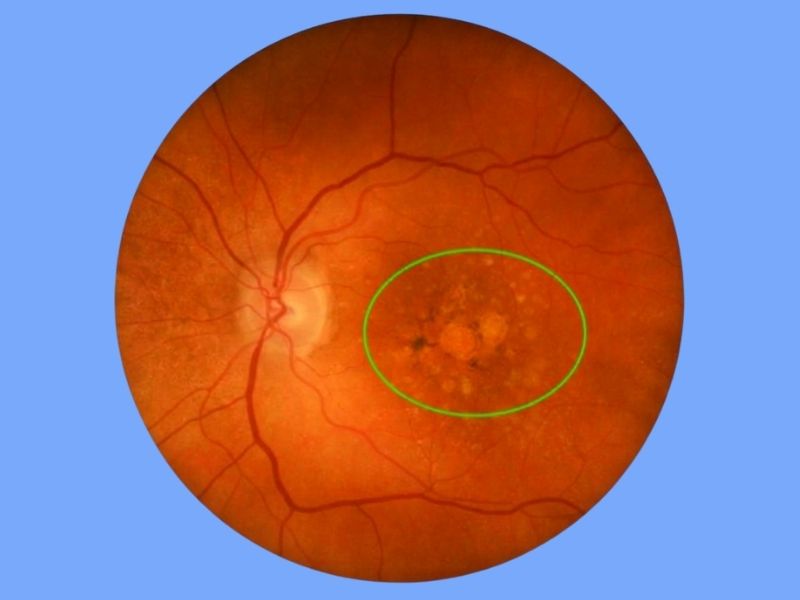Age-Related Macular Degeneration (AMD)
