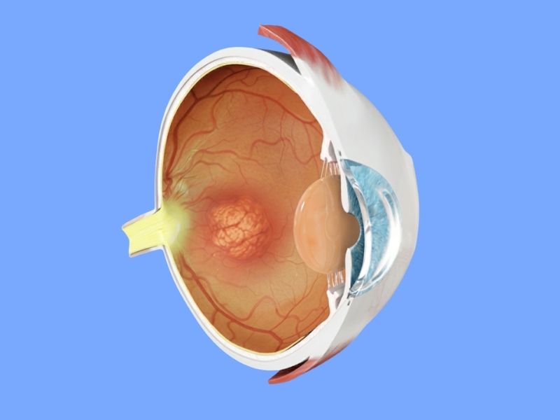 Age-Related Macular Degeneration (AMD)
