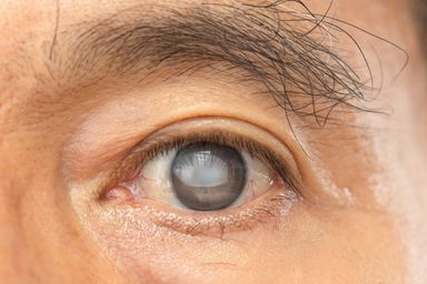 Cataract