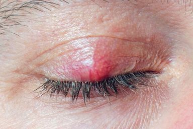 Chalazion
