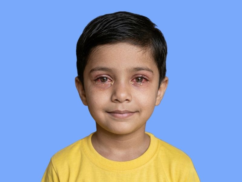 Childhood Eye Infections — temporary reference image