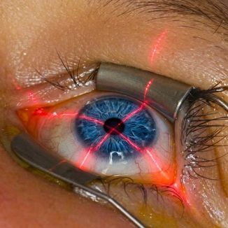Corneal Collagen Cross-Linking (C3R) — temporary reference