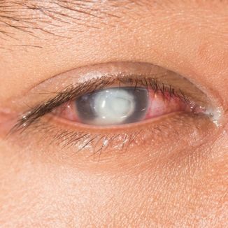 Corneal Infection & Ulcer Treatment — temporary reference