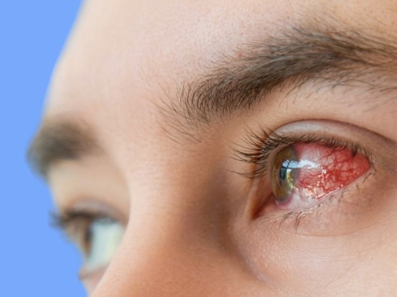 Corneal Infections (Keratitis) — temporary reference