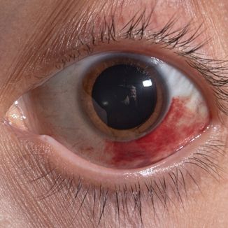 Corneal Injury & Surface Repair — temporary reference