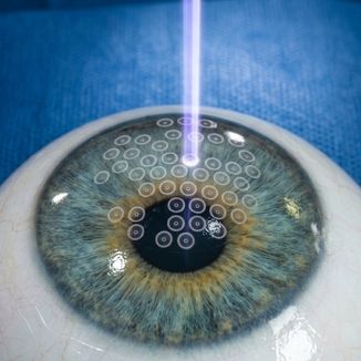 Corneal Laser Treatment (PTK) — temporary reference