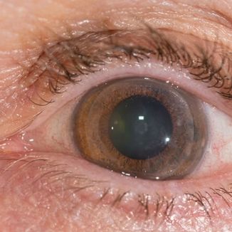 Corneal Transplantation (Keratoplasty) — temporary reference