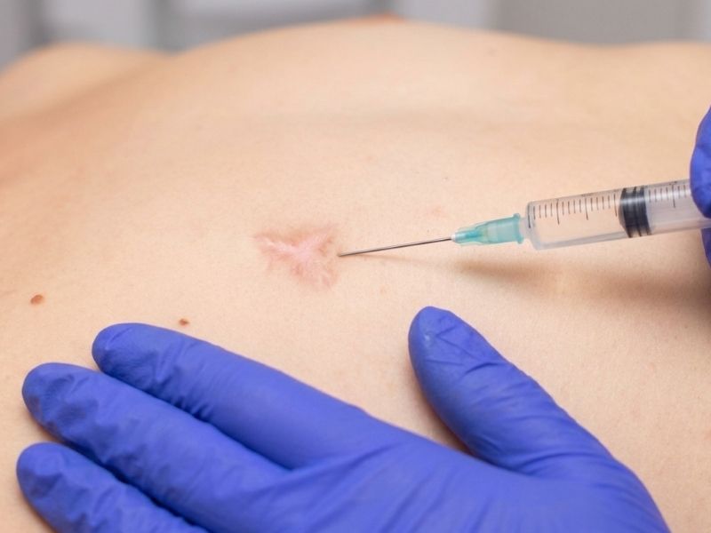 Corticosteroid Therapy