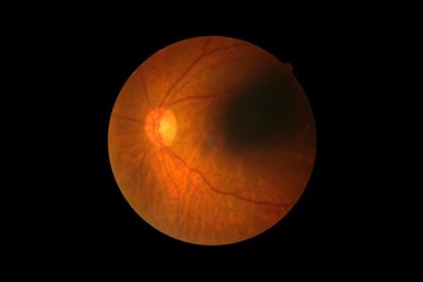 Diabetic Retinopathy
