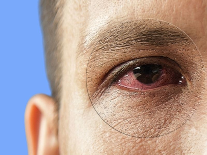 Dry Eye-Related Corneal Damage — temporary reference