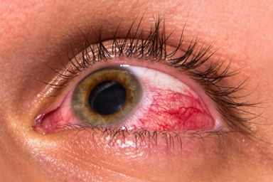 Dry Eye Syndrome