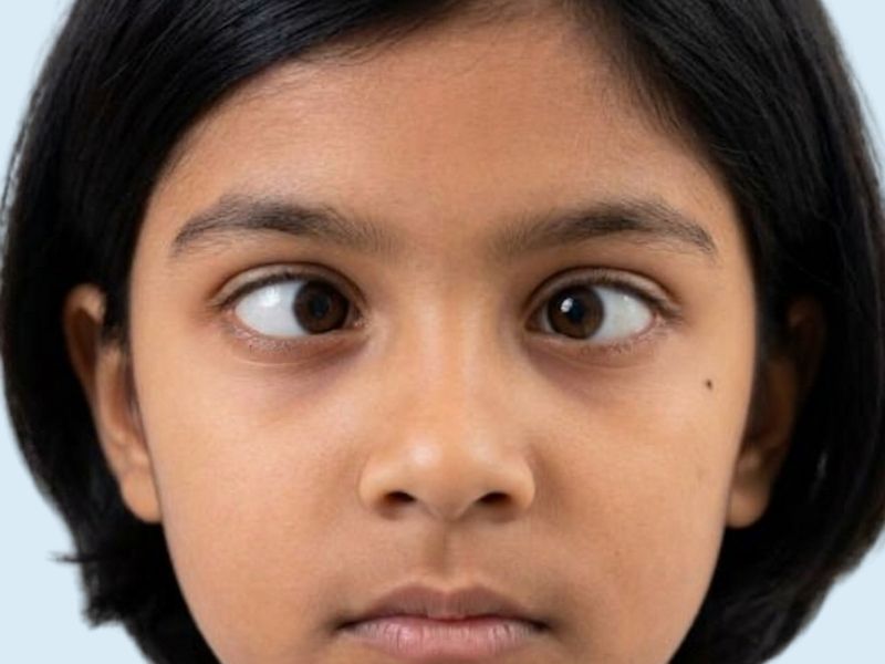Esotropia (Inward Squint)
