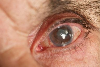 Glaucoma