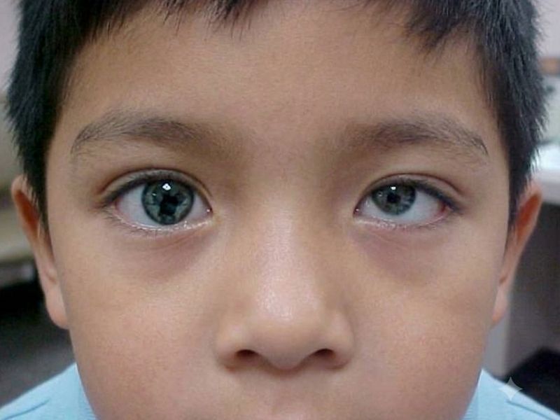 Hypertropia (Upward Squint)