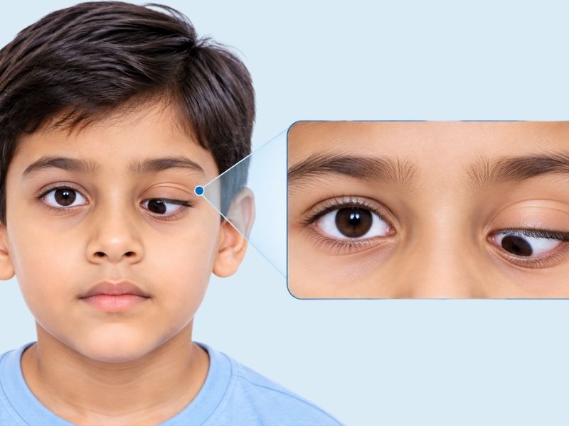 Hypotropia (Downward Squint)