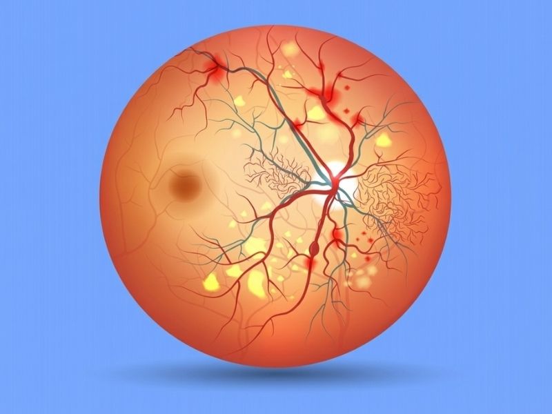 Inherited Retinal Disorders