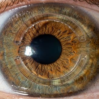 Intracorneal Ring Segments (ICRS) — temporary reference