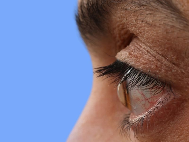 Keratoconus — temporary reference
