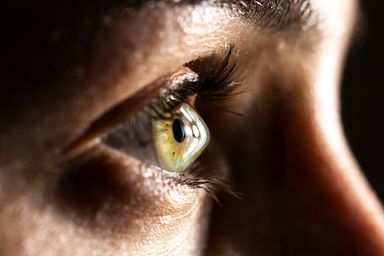 Keratoconus