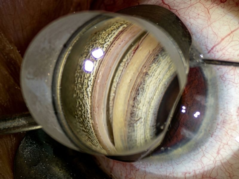 Minimally Invasive Glaucoma Surgery (MIGS) — illustrative image