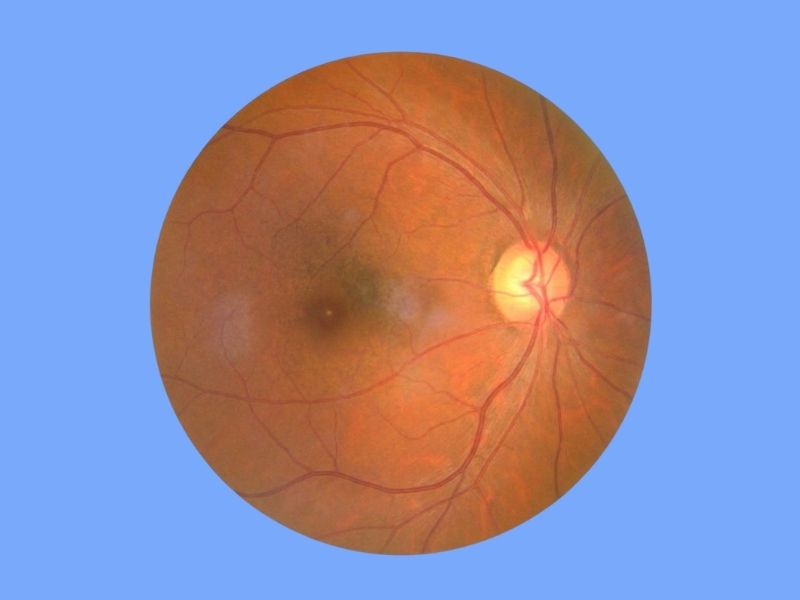 Normal-Tension Glaucoma — temporary reference