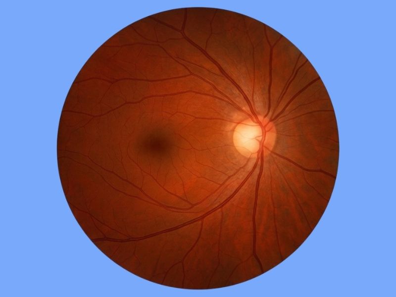 Ischemic Optic Neuropathy