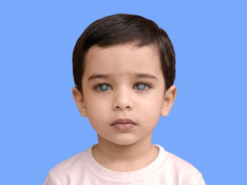 Pediatric Glaucoma — temporary reference image