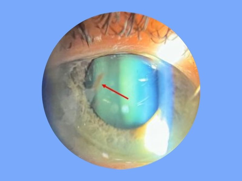 Pigmentary Glaucoma — temporary reference