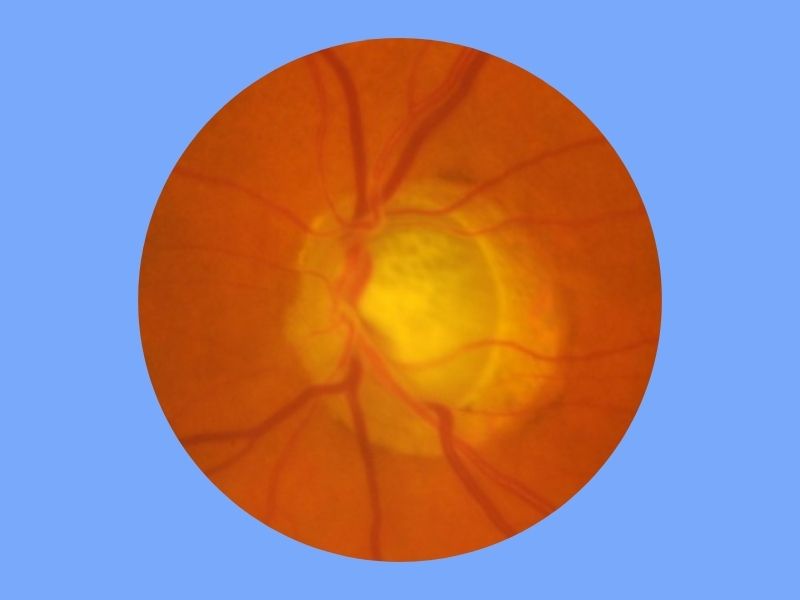Pseudoexfoliative Glaucoma — temporary reference