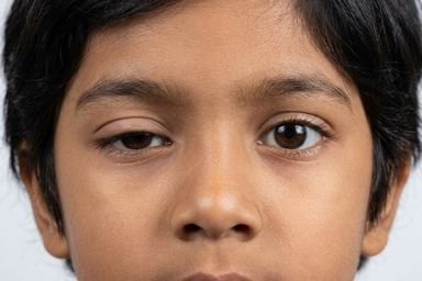 Ptosis Droopy Eyelid