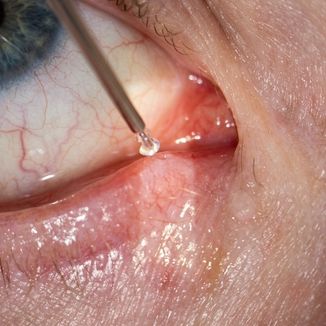 Temporary Retina reference image 6 — replace with clinic-specific image