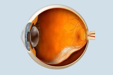 Retinal Detachment