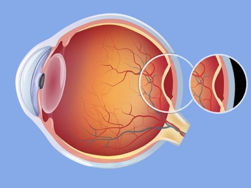 Retinal Tears & Retinal Detachment
