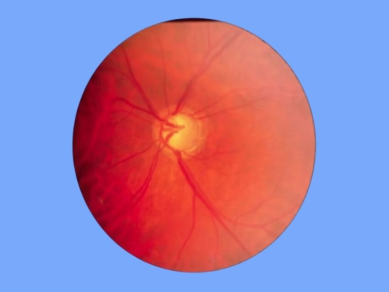 Secondary Glaucoma — temporary reference