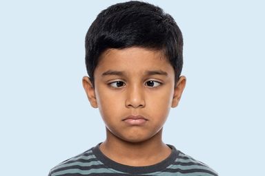 Strabismus Squint