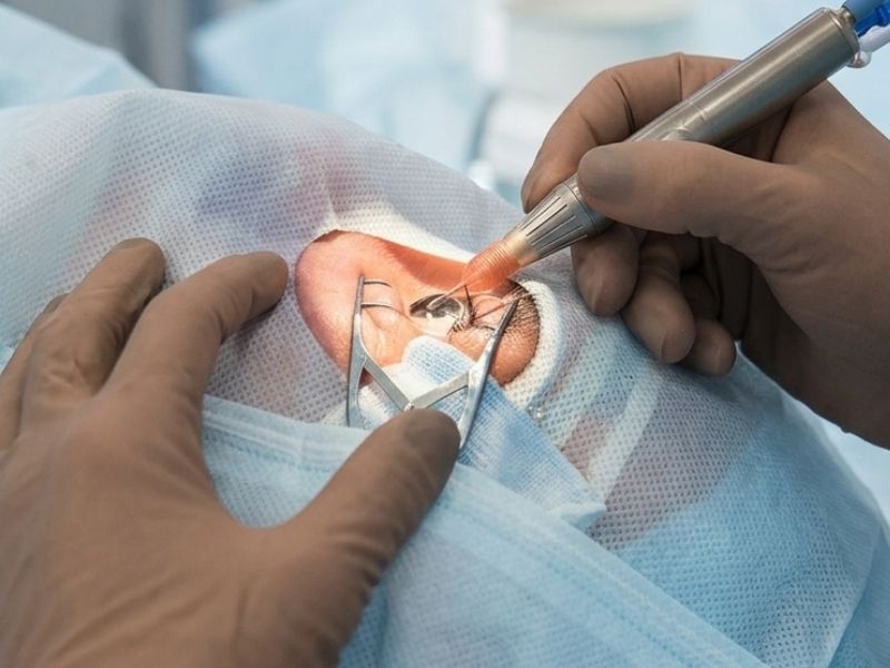 Trabeculectomy Surgery — illustrative image