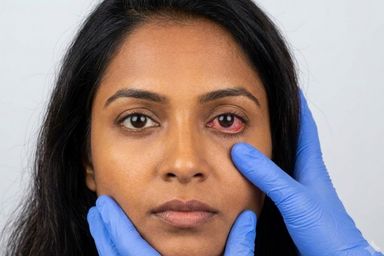 Uveitis