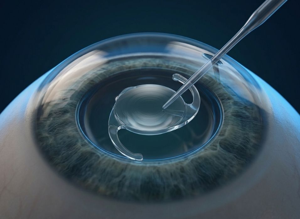 Lens-based eye surgery illustration